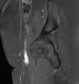 Broad ligament leiomyoma (Radiopaedia 81634-95516 G 3).jpg