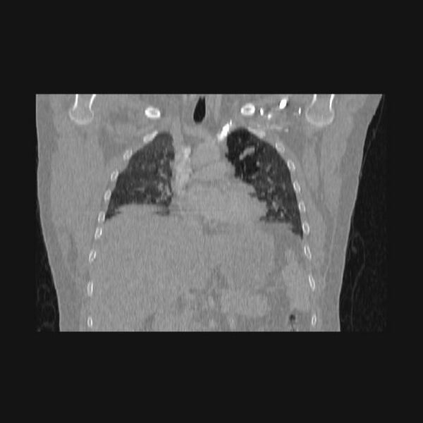 File:Bronchial atresia (Radiopaedia 60685-68439 Coronal lung window 42).jpg