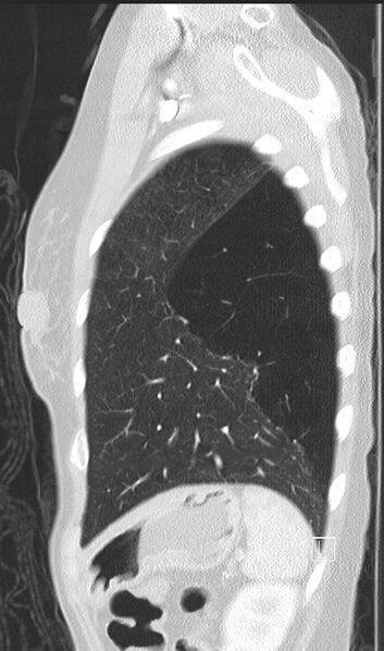 File:Bronchial atresia (Radiopaedia 73677-84470 Sagittal lung window 46).jpg