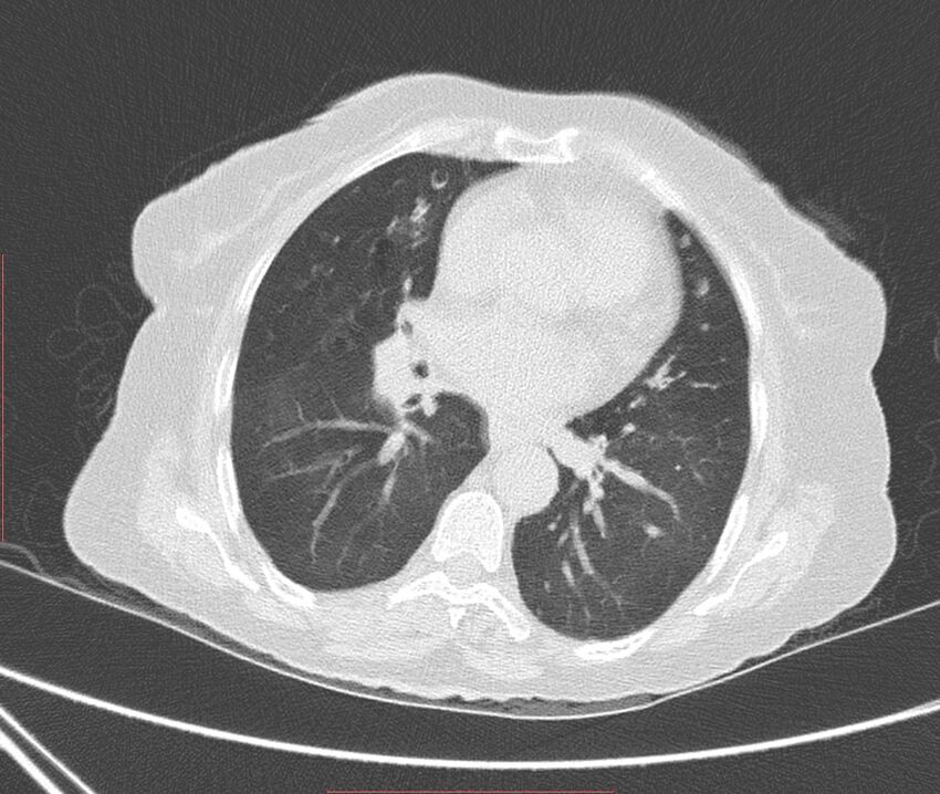 Bronchiectasis (Radiopaedia 72693-83293 Axial lung window 75).jpg