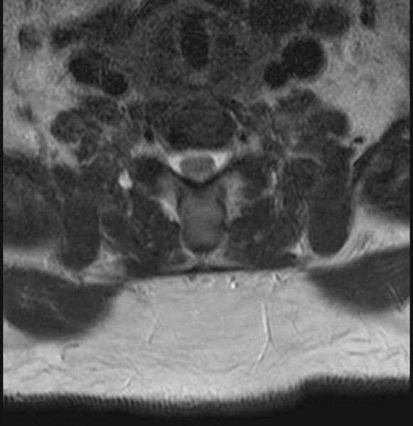 File:Brown tumors compressing the spinal cord (Radiopaedia 68442-78030 A 58).jpg