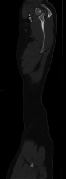 File:Burst fracture (Radiopaedia 83168-97542 Sagittal bone window 20).jpg
