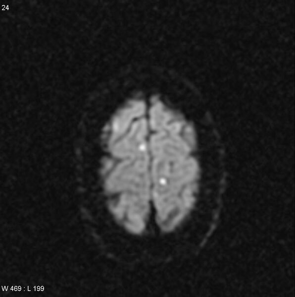 File:CMV ventriculitis and encephalitis (Radiopaedia 5416-7166 Axial DWI 10).jpg