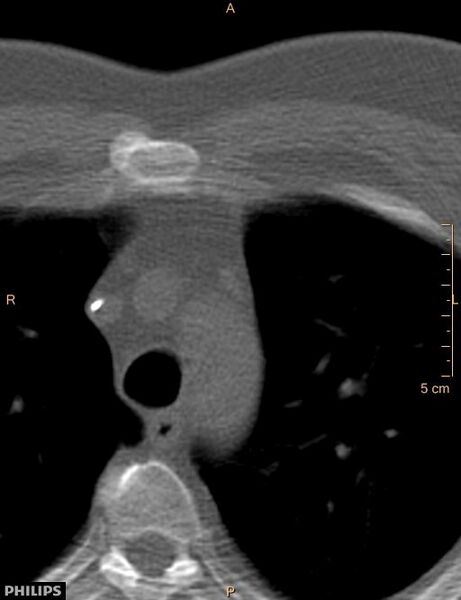 File:Calcified cardiac fibroma (Radiopaedia 39267-41519 Axial bone window 2).jpg
