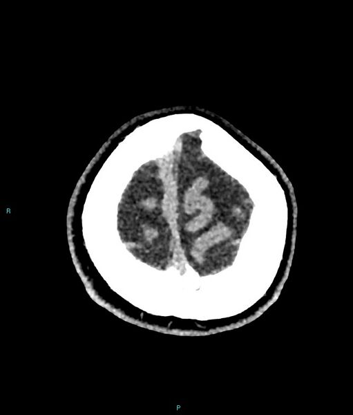 File:Calcified cerebral emboli from left ventricular thrombus (Radiopaedia 84420-99758 Axial non-contrast 10).jpg