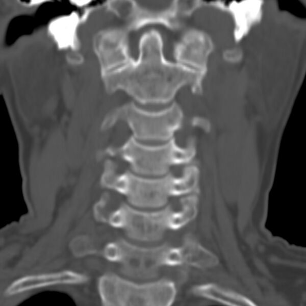 File:Calcified meningioma - cervical canal (Radiopaedia 70136-80171 Coronal bone window 5).jpg