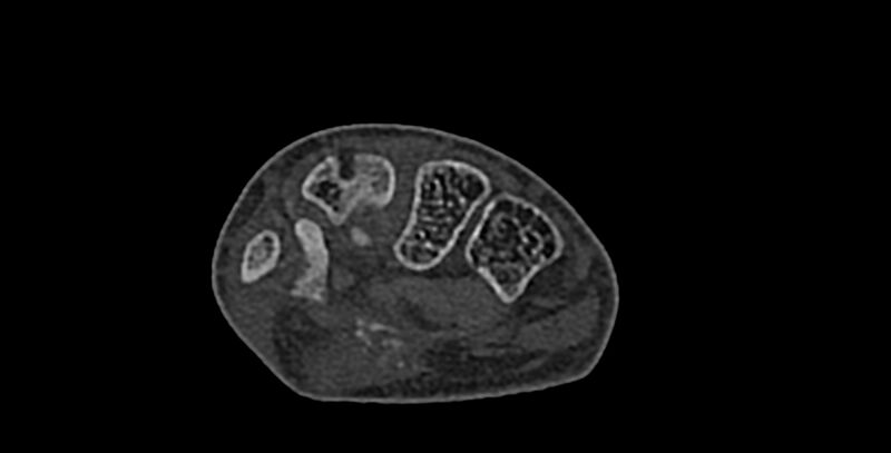 File:Calcifying aponeurotic fibroma (Radiopaedia 88423-105064 Axial bone window 106).jpg