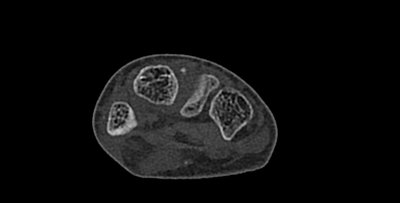File:Calcifying aponeurotic fibroma (Radiopaedia 88423-105064 Axial bone window 112).jpg