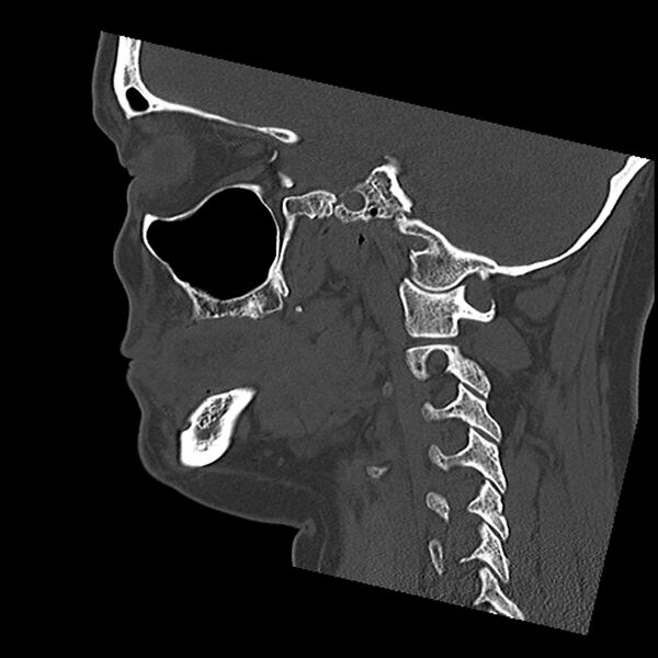 File:Canal up mastoidectomy (Radiopaedia 78108-90638 Sagittal bone window 25).jpg