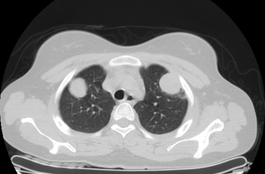 Cannonball metastases - uterine choriocarcinoma (Radiopaedia 70137-80173 Axial lung window 10).jpg