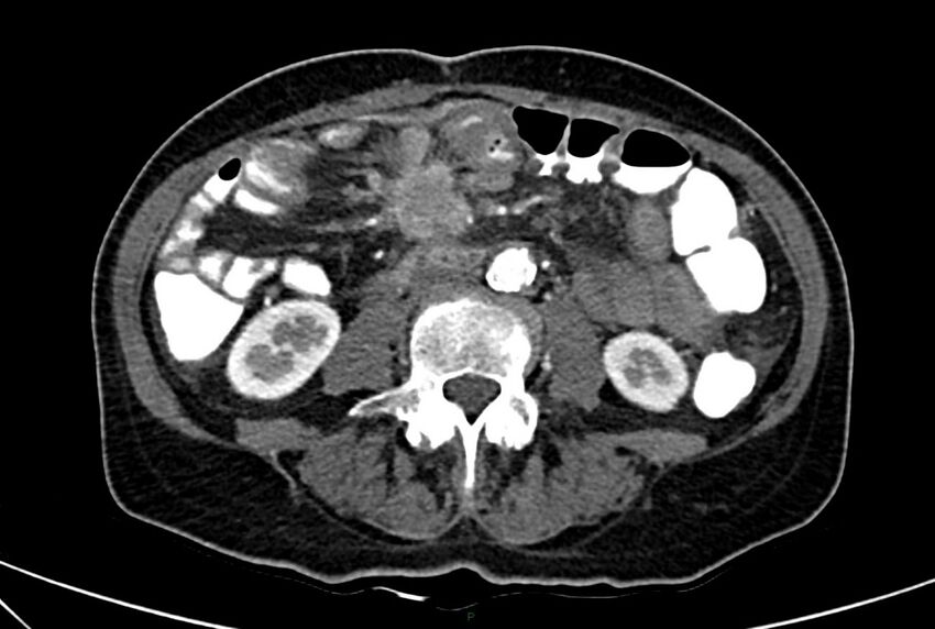 Carcinoid mesenteric tumor complicated by chylous ascites (Radiopaedia 76312-88926 A 39).jpg