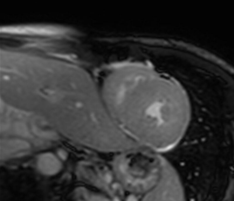 Cardiac amyloidosis (Radiopaedia 39736-42124 F 157).jpg