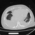 Cardiogenic pulmonary edema (Radiopaedia 29213-29609 Axial lung window 70).jpg