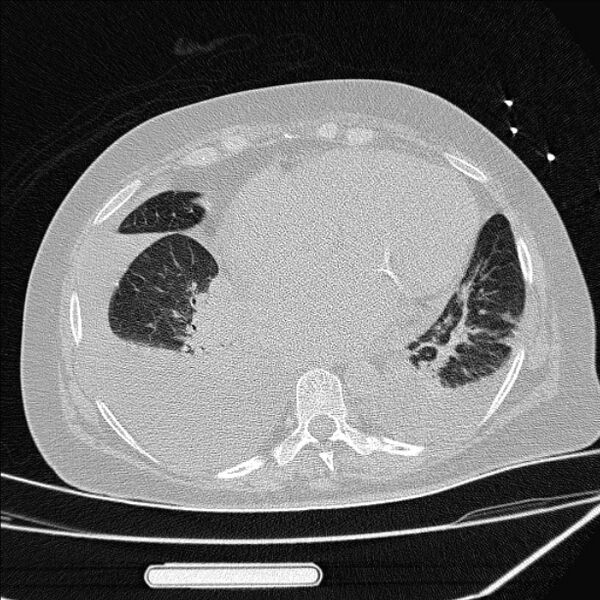 File:Cardiogenic pulmonary edema (Radiopaedia 29213-29609 Axial lung window 70).jpg