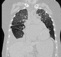 Cardiogenic pulmonary edema (Radiopaedia 29213-29609 Coronal lung window 27).jpg