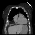 Cardiogenic pulmonary edema (Radiopaedia 29213-29609 Coronal non-contrast 8).jpg