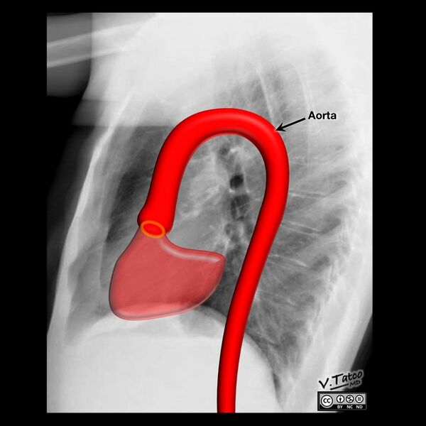 File:Cardiomediastinal anatomy on chest radiography (annotated images) (Radiopaedia 46331-50772 Q 7).jpeg