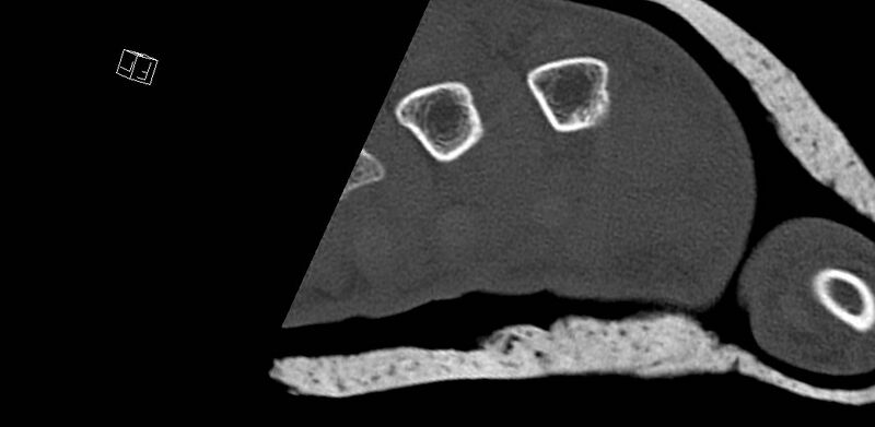 File:Carpal fractures (smart watch impaction) (Radiopaedia 55844-62430 Axial bone window 74).jpg