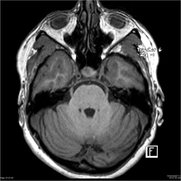 File:Cavernous malformation (cavernous angioma or cavernoma) (Radiopaedia 36675-38237 Axial T1 32).jpg