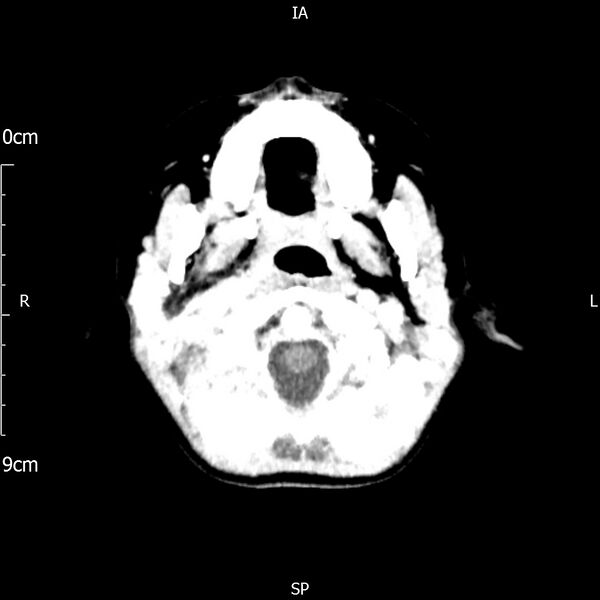 File:Cavernous sinus thrombosis (Radiopaedia 79414-92510 Axial Brain 43).jpg