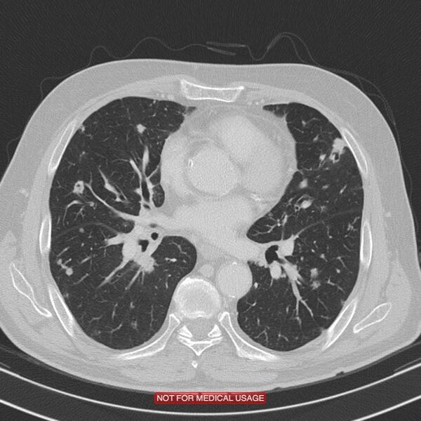 File:Cavitating pulmonary metastases (Radiopaedia 24920-25184 Axial lung window 13).jpg