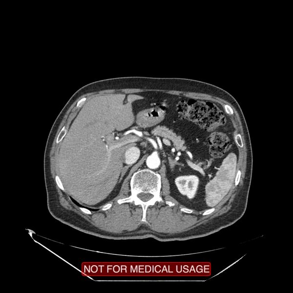 File:Celiac trunk variant anatomy - gastrohepatic trunk and splenic artery (Radiopaedia 38815-40995 A 21).jpg