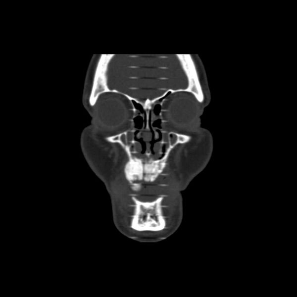 File:Cemento-ossifying fibroma (Radiopaedia 21243-21149 Coronal bone window 5).jpg
