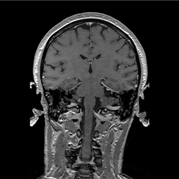 File:Central base of skull meningioma (Radiopaedia 53531-59549 Coronal T1 C+ 30).jpg