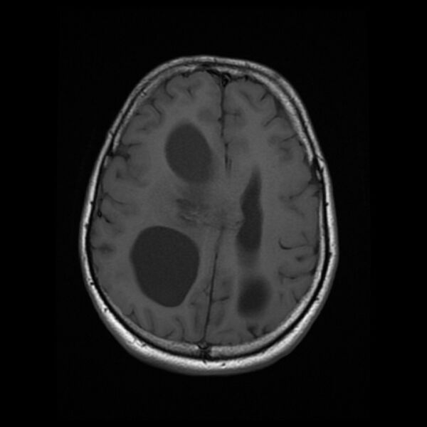 File:Central neurocytoma (Radiopaedia 67618-77021 Axial T1 18).jpg