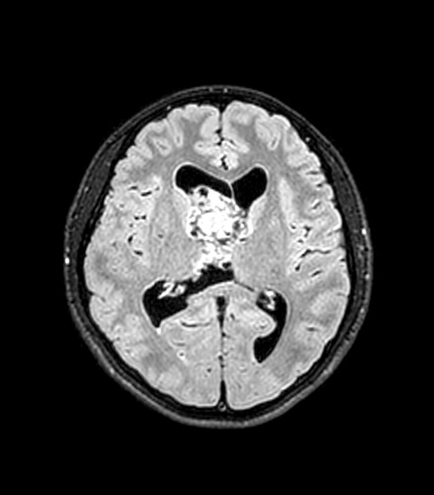 Central neurocytoma (Radiopaedia 79320-92380 Axial FLAIR 150).jpg