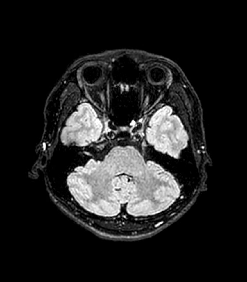 Central neurocytoma (Radiopaedia 79320-92380 Axial FLAIR 224).jpg
