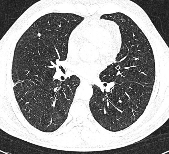 File:Centrilobular pulmonary emphysema (Radiopaedia 26808-26971 Axial lung window 22).jpg
