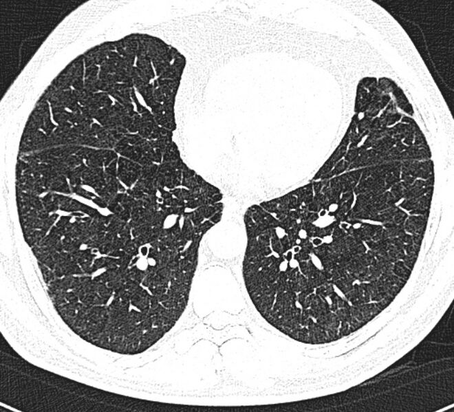File:Centrilobular pulmonary emphysema (Radiopaedia 26808-26971 Axial lung window 27).jpg