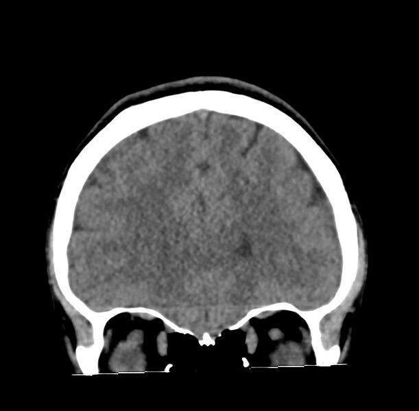 File:Cerebellar agenesis (Radiopaedia 30203-30817 Coronal non-contrast 2).jpg