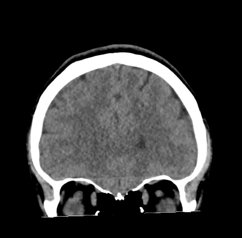 Cerebellar agenesis (Radiopaedia 30203-30817 Coronal non-contrast 2).jpg