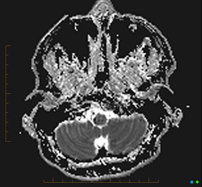 File:Cerebellar gangliocytoma (Radiopaedia 65377-74422 Axial ADC 4).jpg