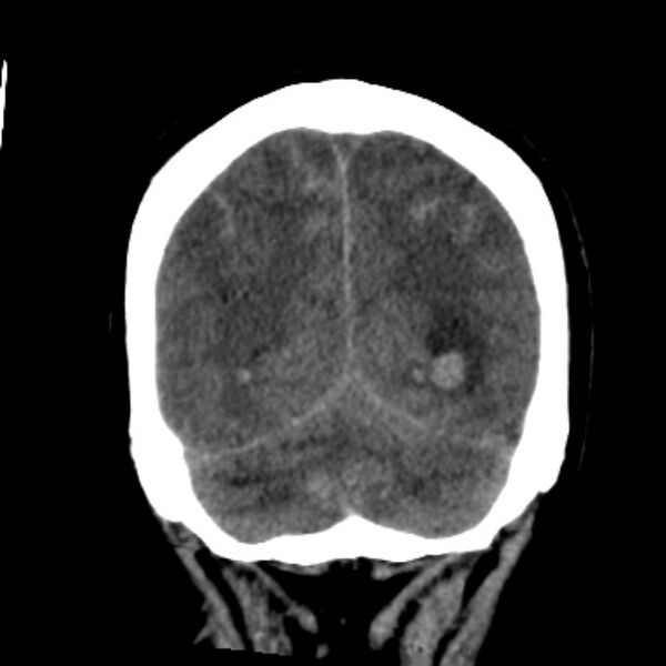 File:Cerebellar hemorrhage causing obstructive hydrocephalus (Radiopaedia 33989-35207 Coronal non-contrast 43).jpg