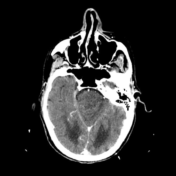 File:Cerebellar metastasis - lung tumor (Radiopaedia 69317-79145 Axial with contrast 14).jpg