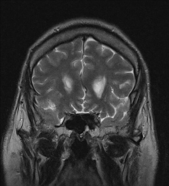 File:Cerebellopontine angle meningioma (Radiopaedia 24459-24764 Coronal T2 6).jpg