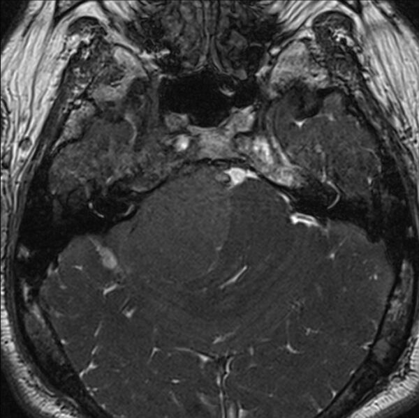 File:Cerebellopontine angle meningioma (Radiopaedia 24459-24764 I 26).jpg
