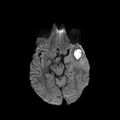 Cerebral abscess post cardiac surgery (Radiopaedia 27244-27420 Axial DWI 7).jpg