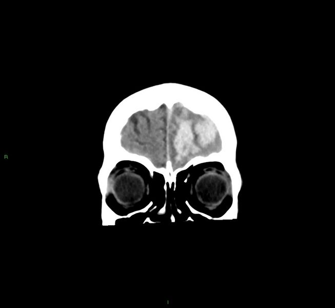 File:Cerebral amyloid angiopathy-associated lobar intracerebral hemorrhage (Radiopaedia 58561-65724 Coronal non-contrast 53).jpg