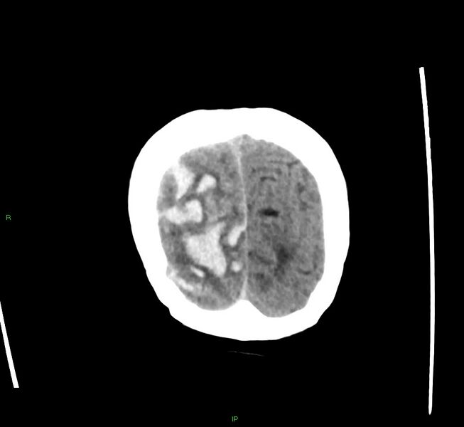 File:Cerebral amyloid angiopathy-associated lobar intracerebral hemorrhage (Radiopaedia 58563-65727 Coronal non-contrast 11).jpg