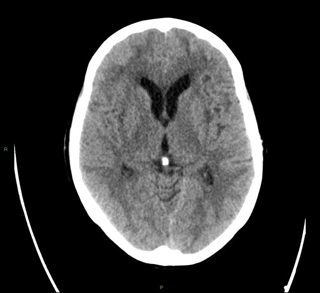 File:Cerebral amyloid angiopathy-associated lobar intracerebral hemorrhage (Radiopaedia 58566-65731 Axial non-contrast 12).jpg