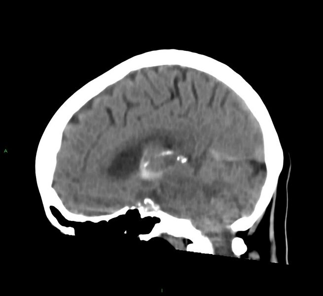 File:Cerebral amyloid angiopathy-associated lobar intracerebral hemorrhage (Radiopaedia 58754-65975 C 22).jpg