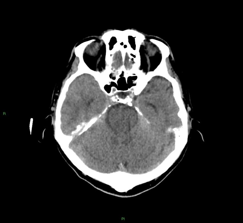 Cerebral amyloid angiopathy-associated lobar intracerebral hemorrhage (Radiopaedia 58756-65977 Axial non-contrast 36).jpg