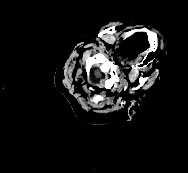 File:Cerebral amyloid angiopathy-associated lobar intracerebral hemorrhage (Radiopaedia 58757-65979 Axial non-contrast 7).jpg