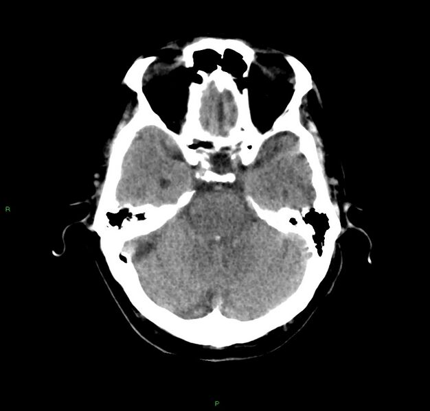 File:Cerebral amyloid angiopathy-associated lobar intracerebral hemorrhage (Radiopaedia 59356-66716 Axial non-contrast 33).jpg