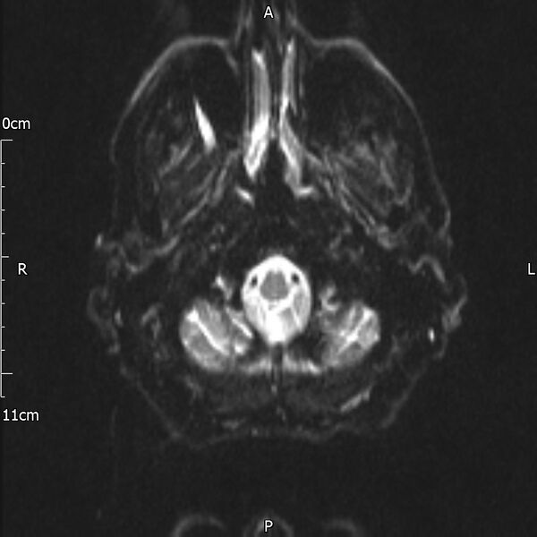 File:Cerebral amyloid angiopathy related inflammation (Radiopaedia 72772-83415 Axial DWI 3).jpg