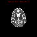 Cerebral and orbital tuberculomas (Radiopaedia 13308-13311 Axial DWI 30).jpg